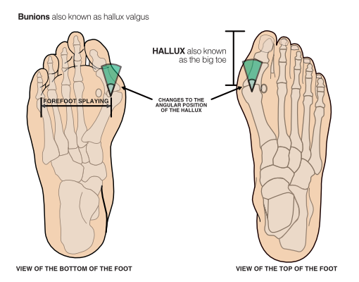 Bunions