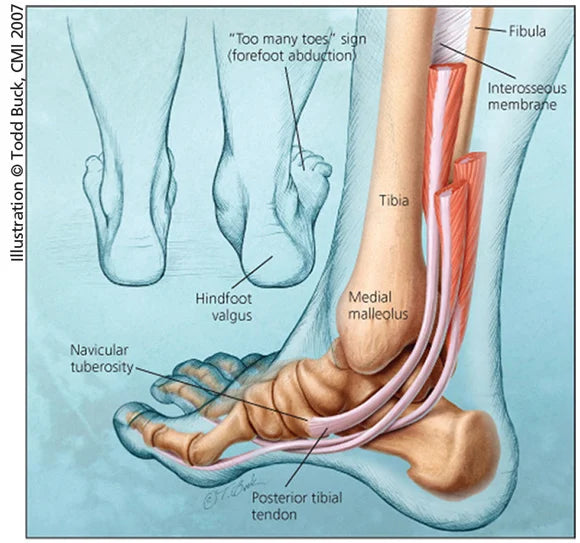 Posterior Tibialis Dysfunction
