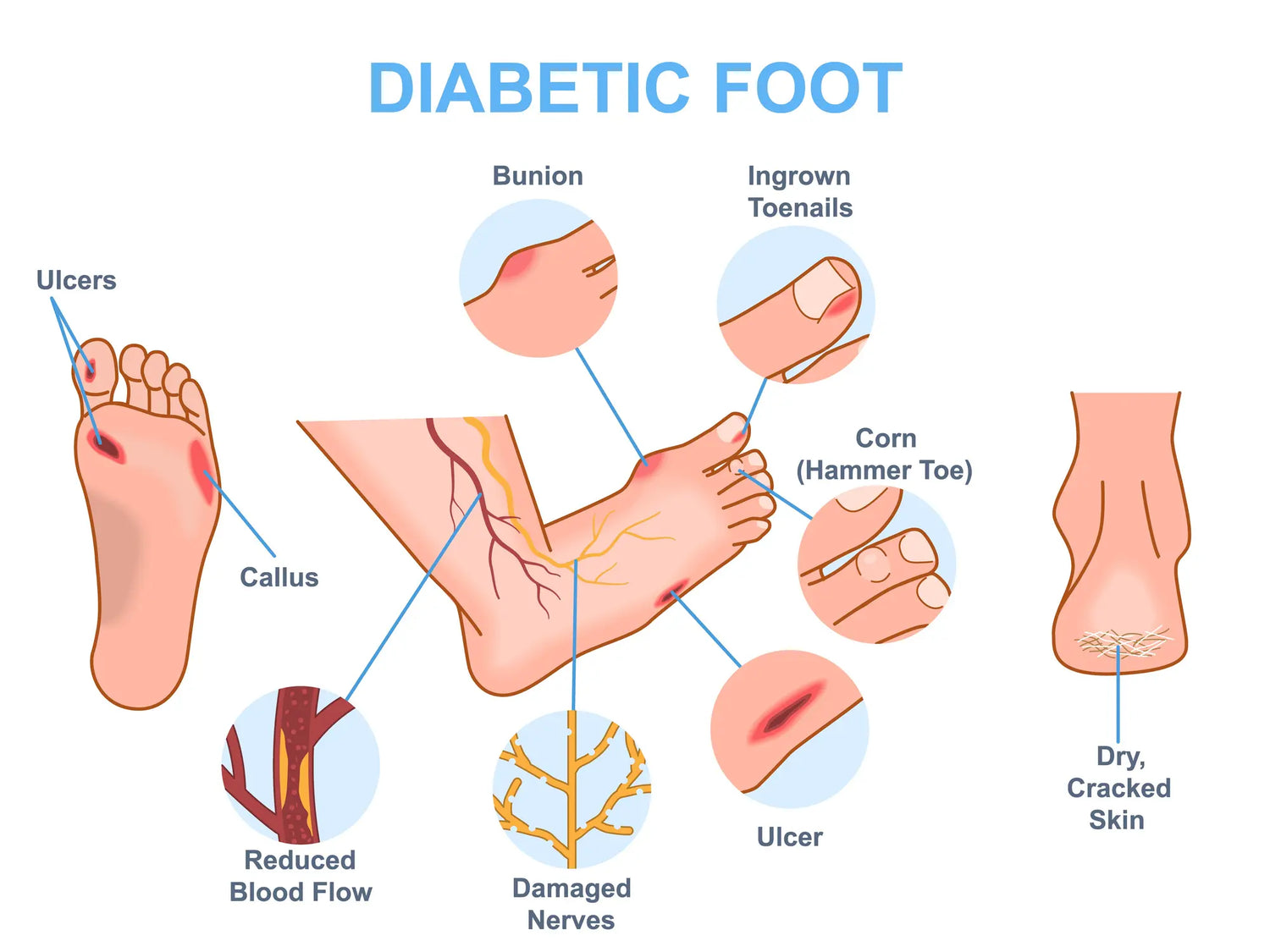 Diabetes