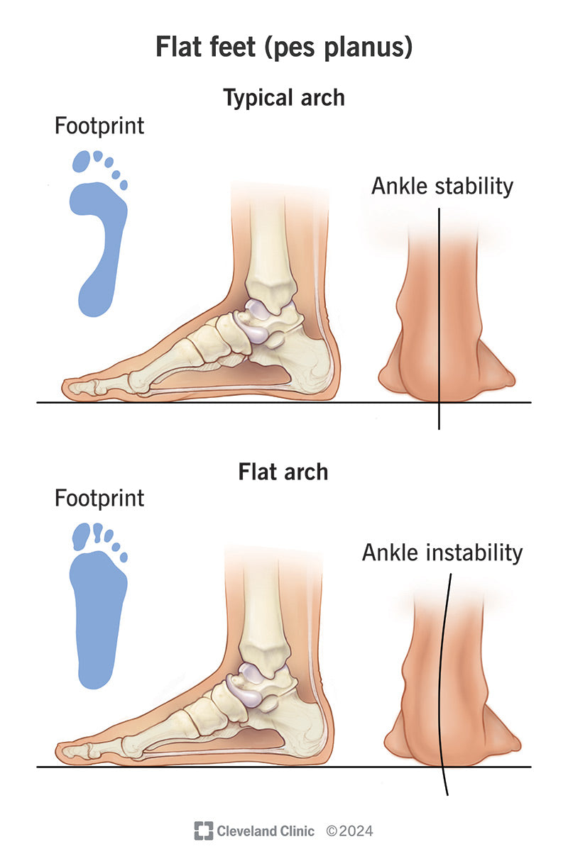 Flat Feet (Pes Planus)