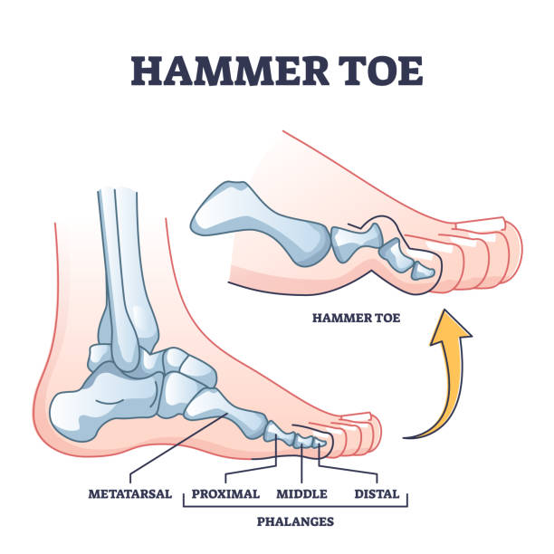 Hammer Toes