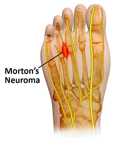 Morton's Neuroma