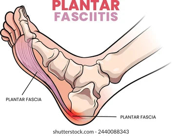 Plantar Fasciitis